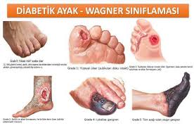 Diyabet Hastaları Mutlaka Bilmesi Gerekenler