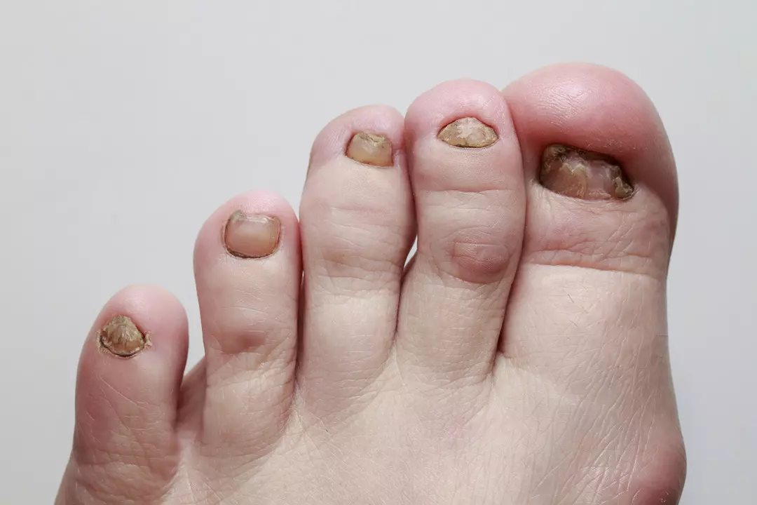 Tırnak Deformasyonları