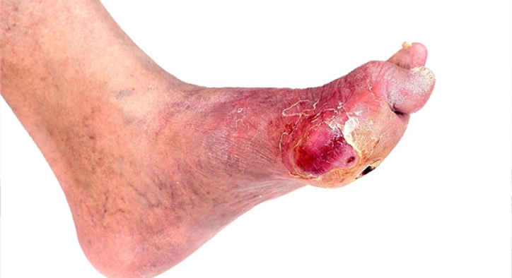 Diyabetik Ayak Bakımı