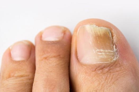 Tırnak Yatağında Bozulma